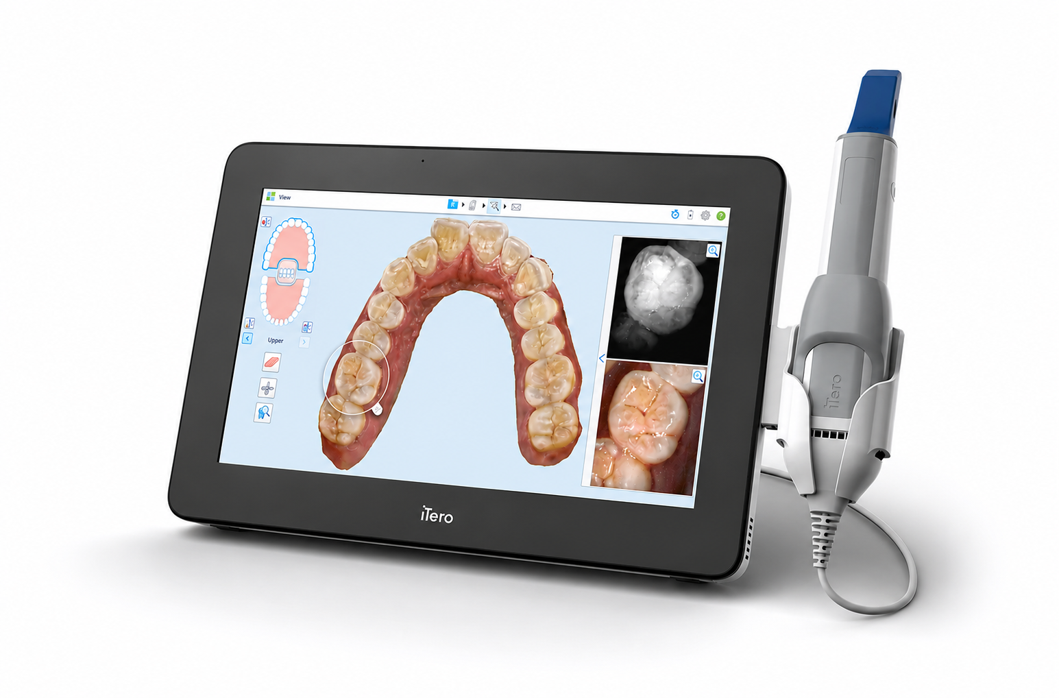 iTero digital scanning for orthodontic treatment planning