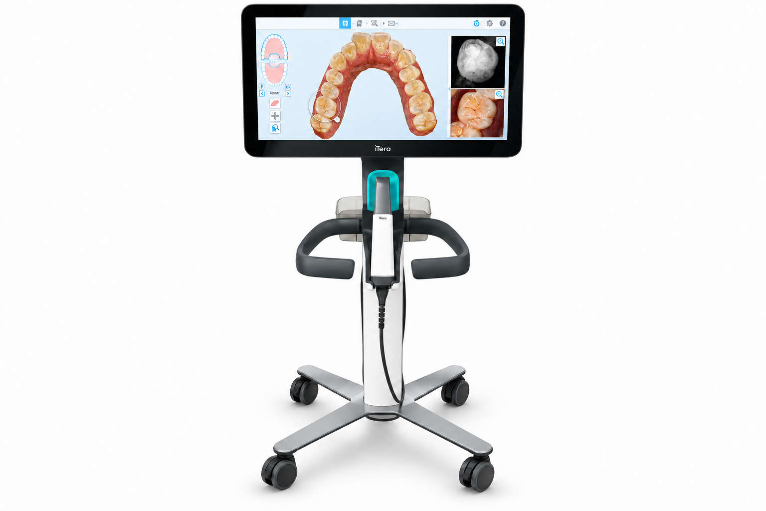iTero digital scanning for orthodontic treatment planning
